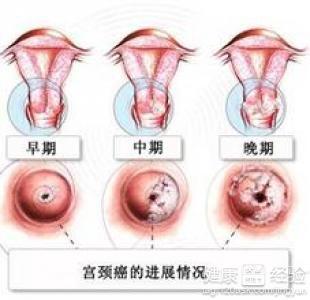 全球首个针对宫颈HSIL非手术类产品国际III期临床试验达成主要终点，引领宫颈健康革新