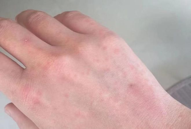 天气干燥引发丘疹，成因、预防与应对策略