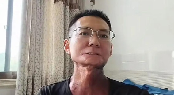甲亢哥槟榔之痛背后的故事