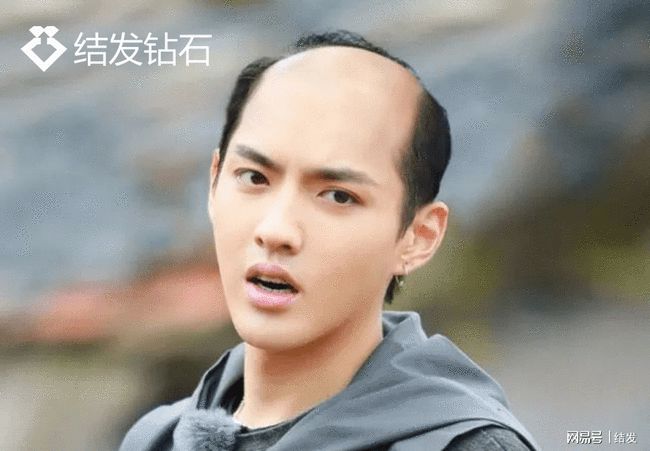 科技与发型重塑的奇迹，男子秃头变茂密秘籍