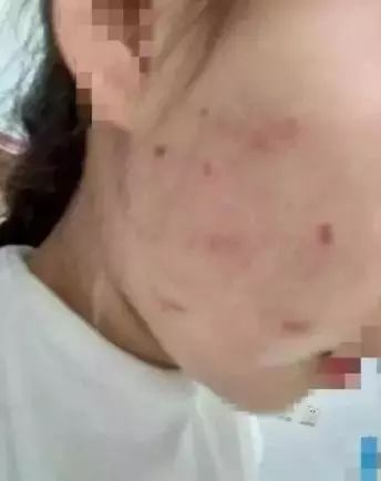实习幼师抓伤幼儿脸事件，赔偿背后的深度解析