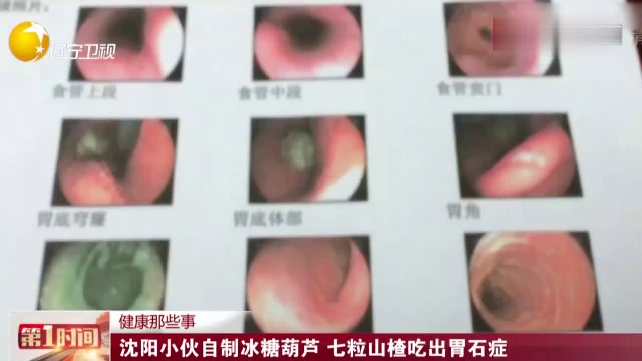 男子贪吃雪花山楂引发胃结石警示公众，贪食零食需警惕健康风险