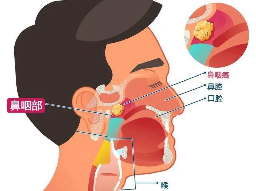 青春阴霾下的鼻咽癌诊断之路，一名15岁男孩的抗癌之旅