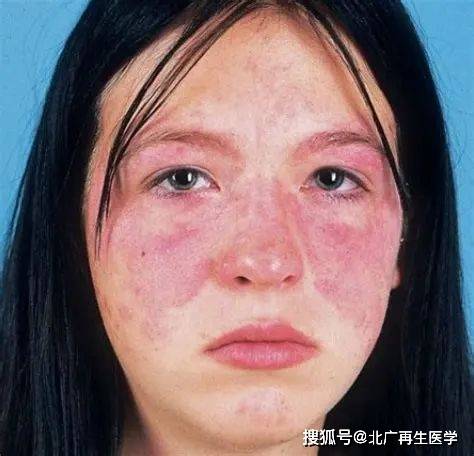 红斑狼疮，每次复发的挑战与应对