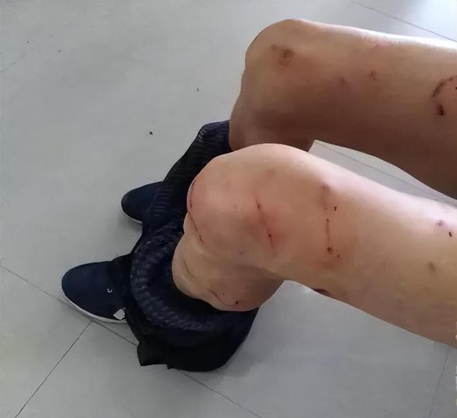 杭州男子被狗抓伤后离世事件，悲剧引发的警示与反思