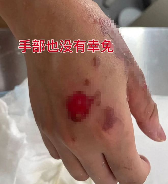 女子餐厅用餐遭遇卡式炉爆炸，受伤缝针长达五十针治疗
