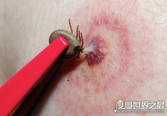 被蜱虫咬伤后的正确应对方法科普文章
