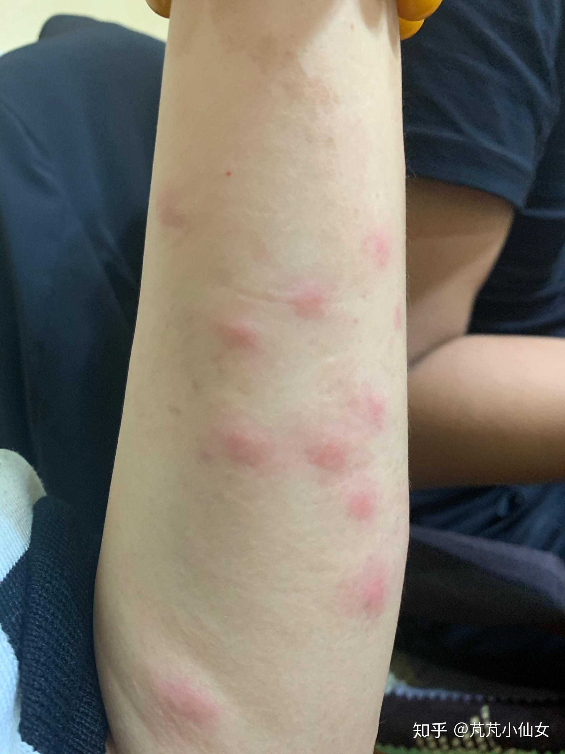 天气升温引发丘疹性荨麻疹高发，预防与应对策略