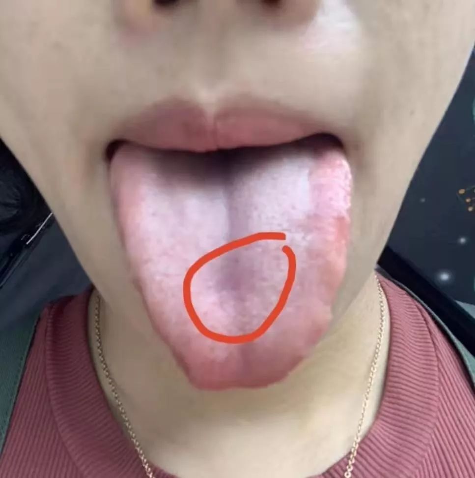 科普博主，如何通过观察舌苔诊断胃溃疡